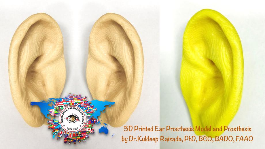 3D Printed Ear prosthesis